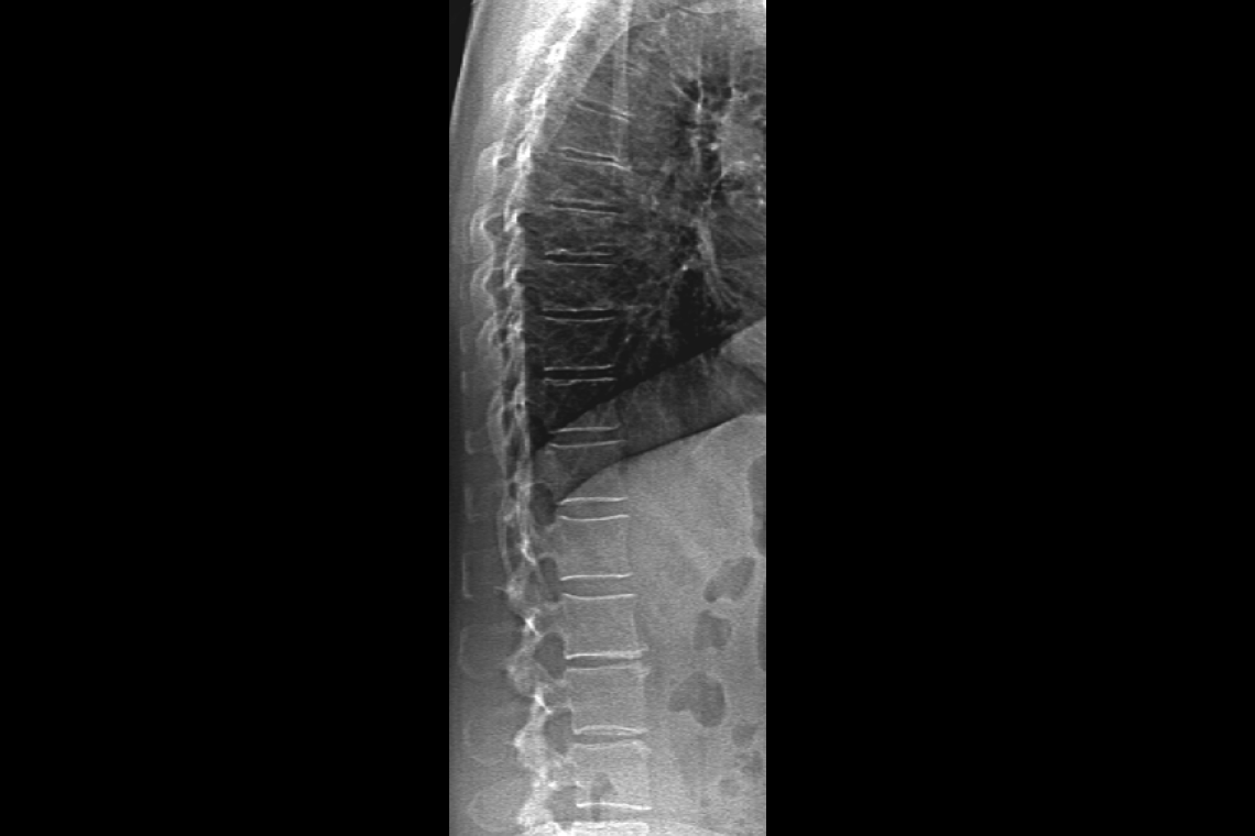 x-ray image of vertebre