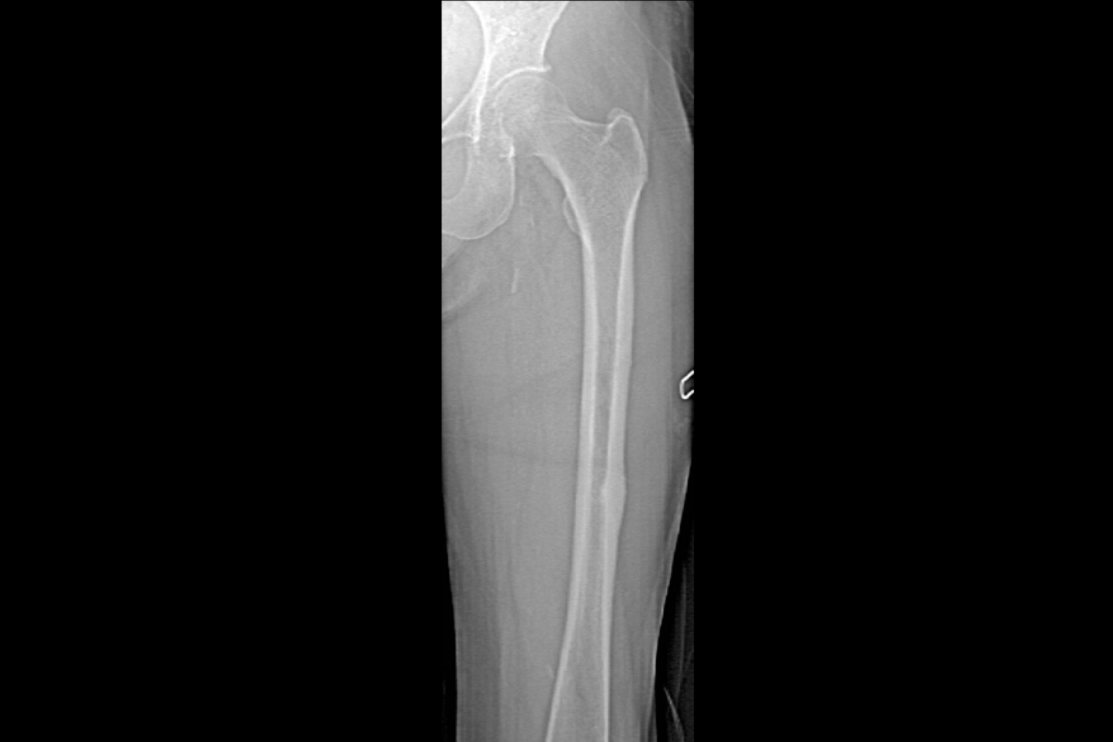x-ray of femur